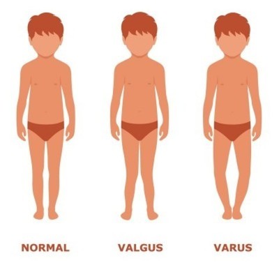 Piernas en X en niños
